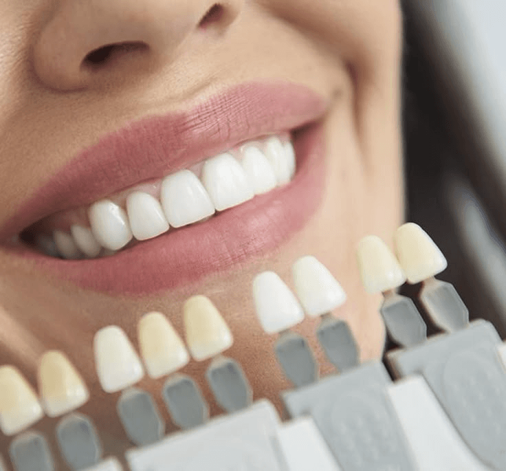 Professional Teeth Whitening Results